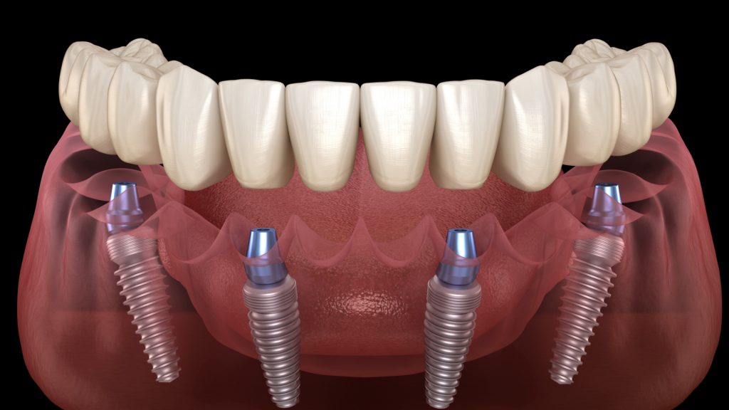 Pack all on 4 implant dentaire portugal