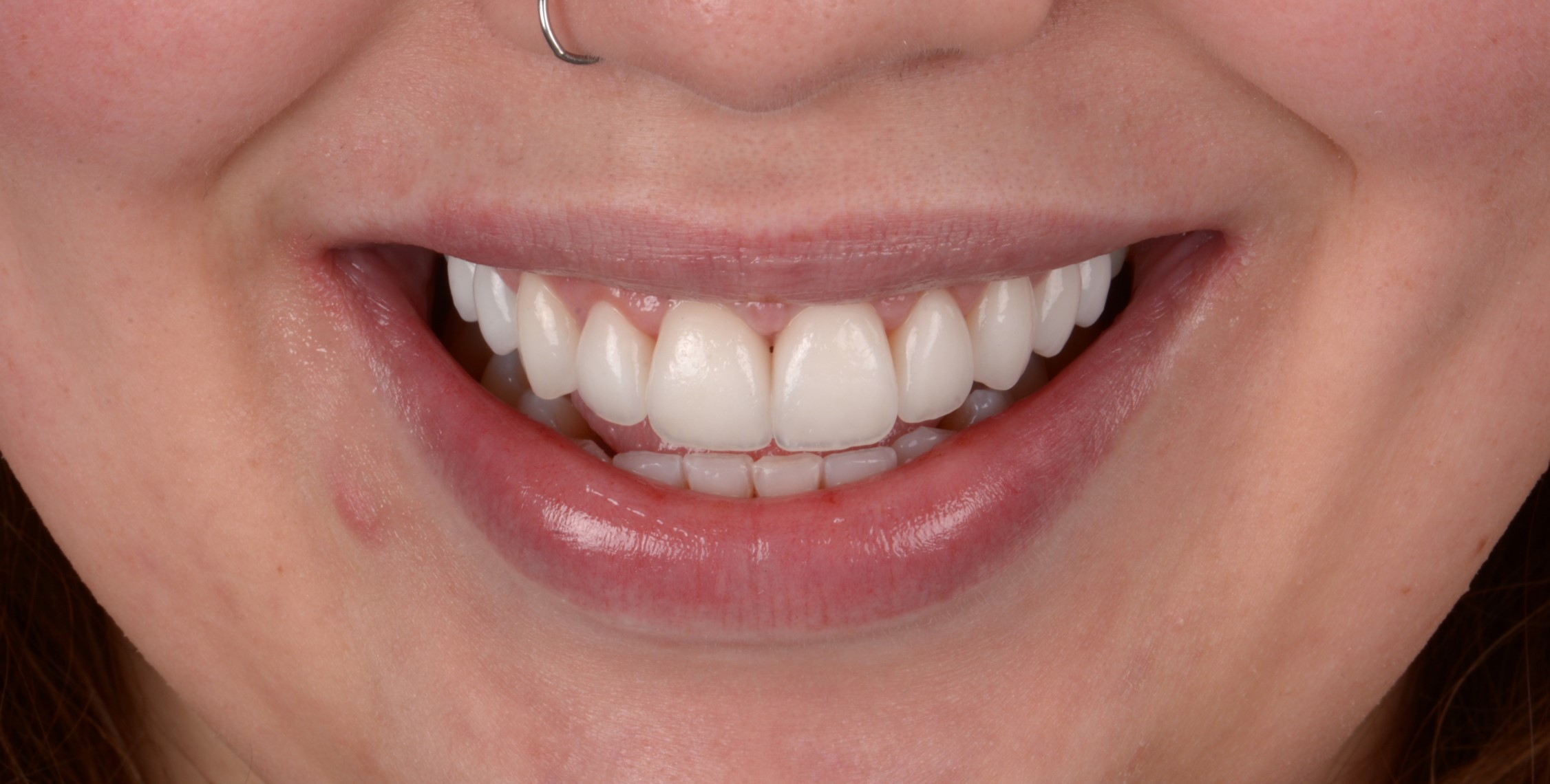 dental veneers à Porto clinique dentaire santa catarina