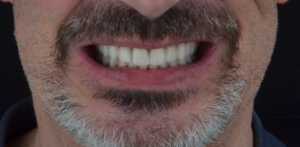 MCI, mise en charge immédiate sur implants