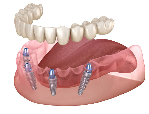 Pack all on 4 implant dentaire portugal