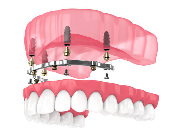 Pack all on 4 implant dentaire portugal