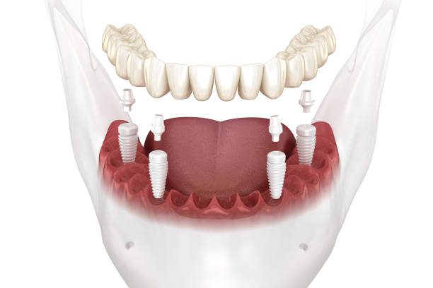 Pack all on 4 implant dentaire portugal