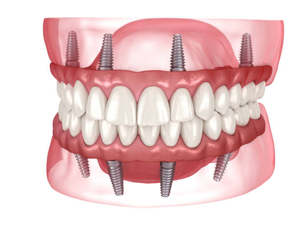 Pack all on 4 implant dentaire portugal