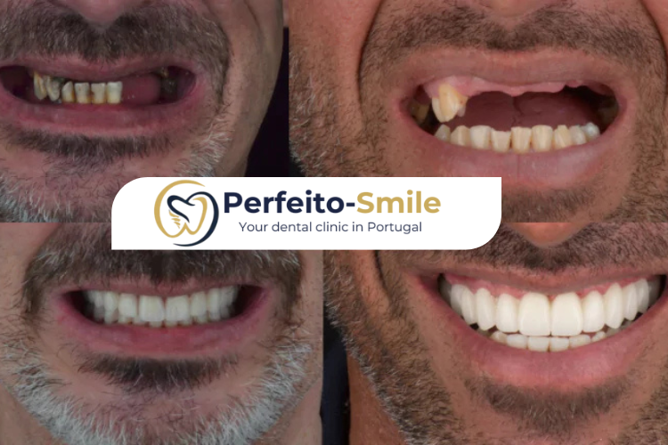 dental implant in porto