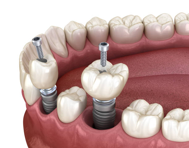 implants dentaires Portugal