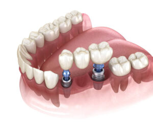 dental implant in Portugal: affordable and top quality