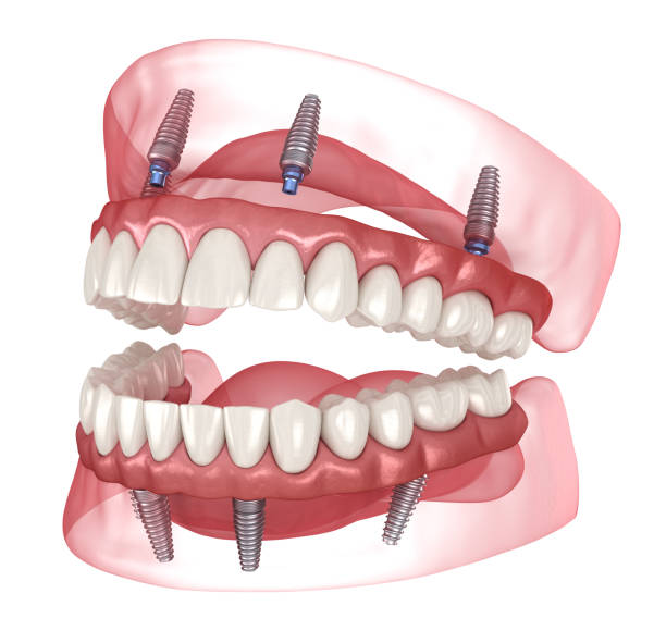 protocole All-on-4 , implants dentaires