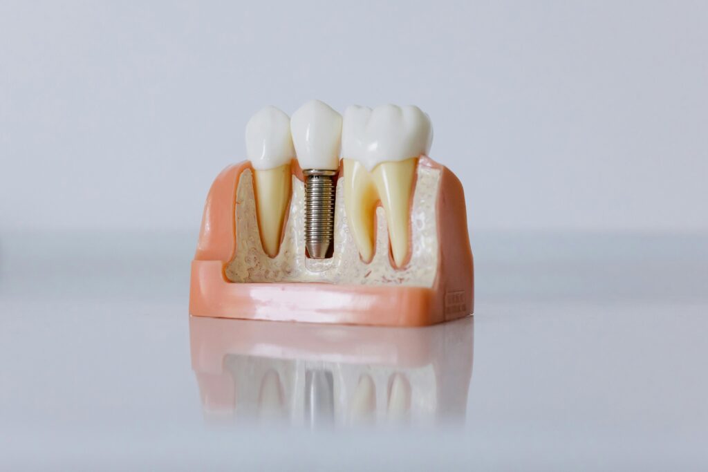 remboursement des soins dentaires : couronne dentaire, implant dentaire