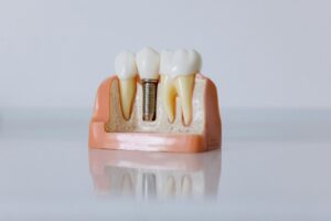 implants dentaires à l'étranger: ce qu'il faut savoir