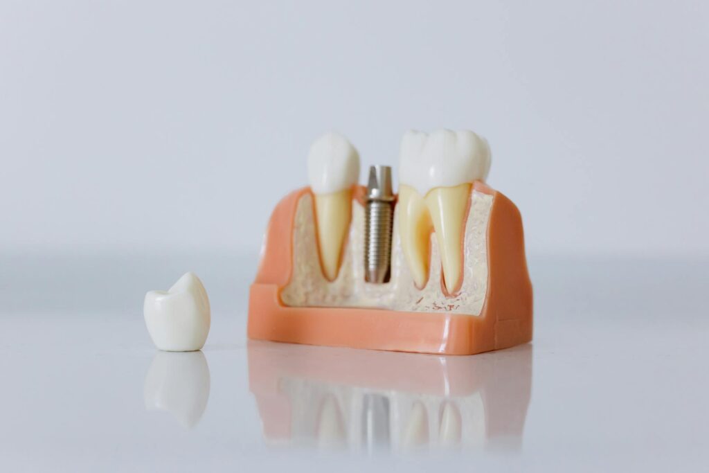 implants dentaires Portugal