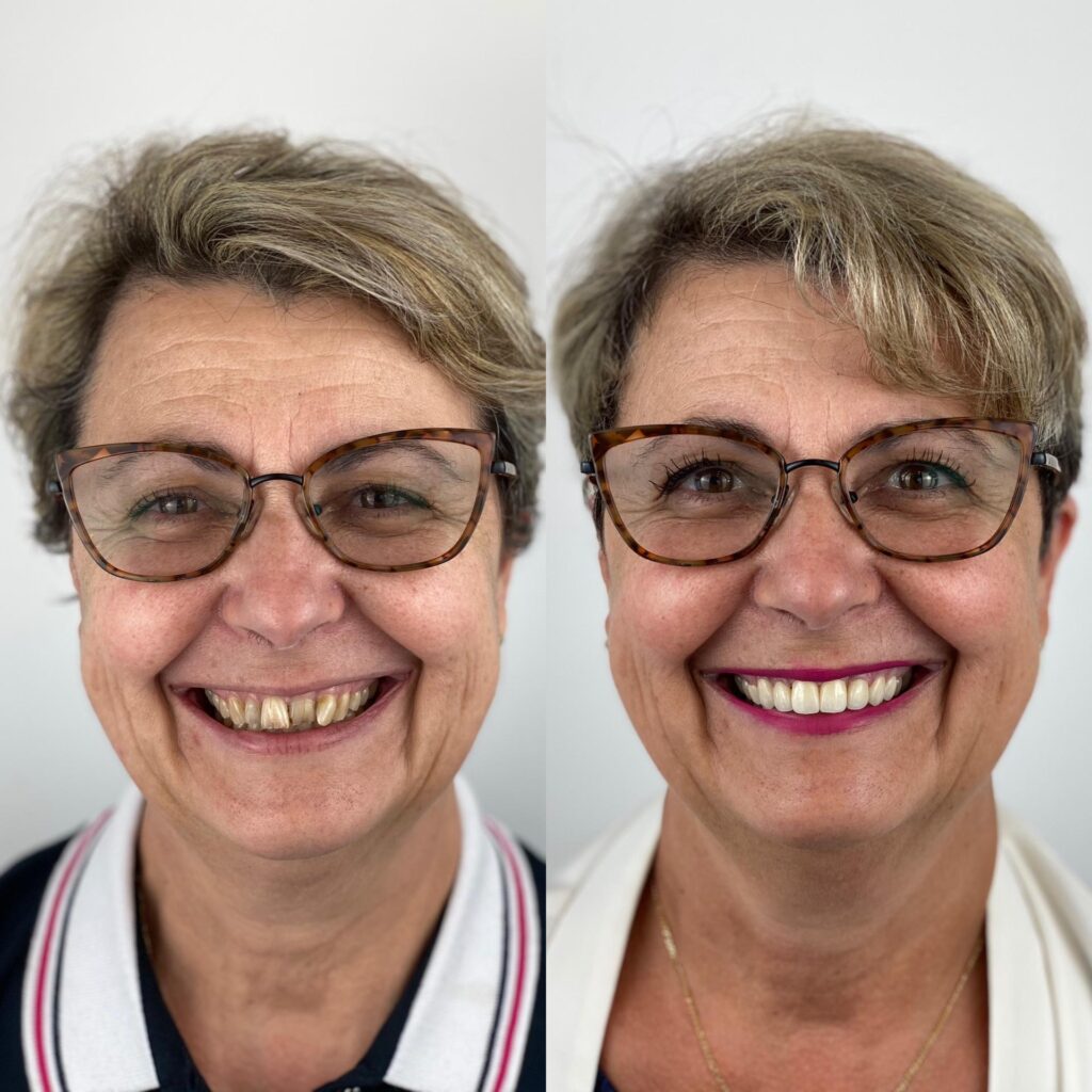 se refaire les dents au Portugal pour les canadiens