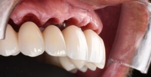 MCI, la mise en charge immédiate sur implants dentaires
