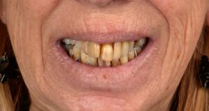 prothèses dentaires à l'étranger fixe sur implants