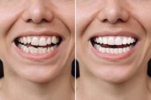 Facettes-dentaire-porto-sourire