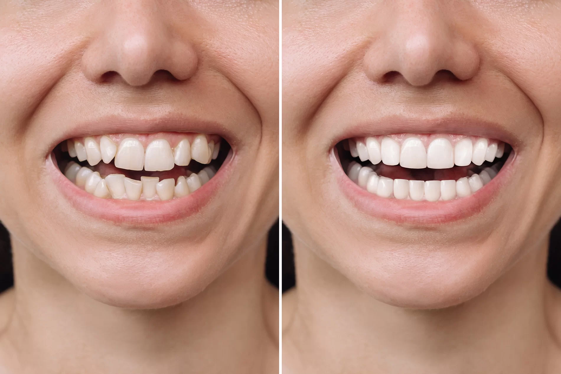 Facettes-dentaire-porto-sourire