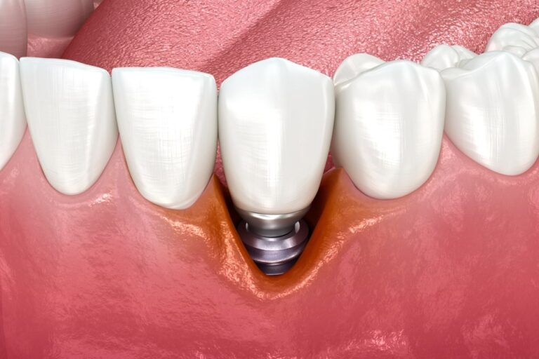 Péri-implantite : comprendre cette infection implant dentaire et éviter la perte de l’implant