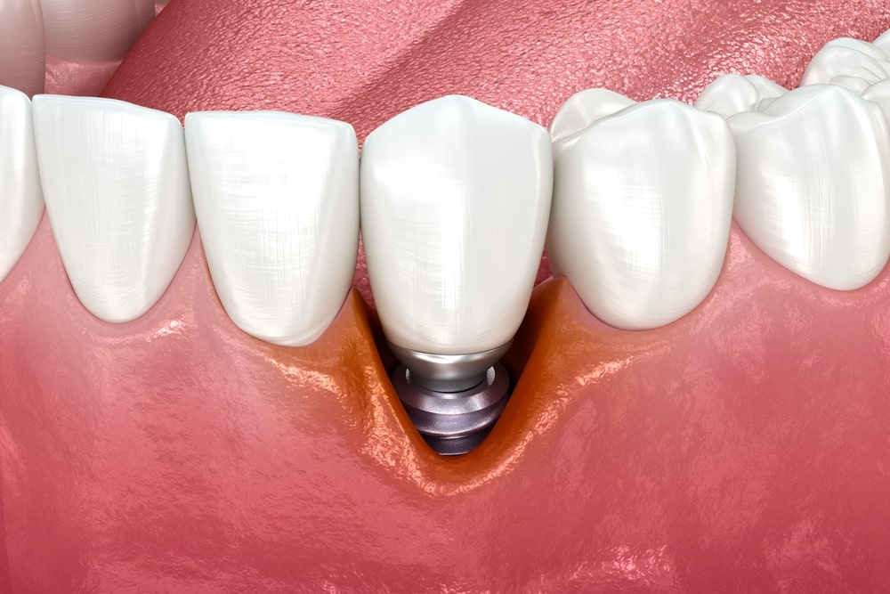 Péri-implantite : comprendre cette infection implant dentaire et éviter la perte de l’implant