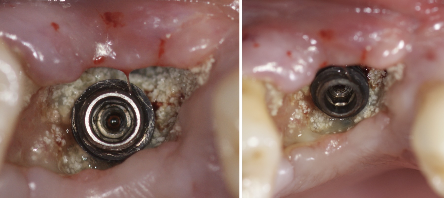 infection implant dentaire, soins dentaires à l'étranger 
