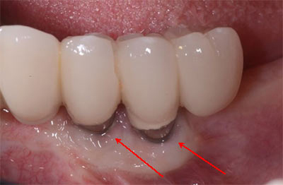 implant dentaire infection, soins dentaire à l'étranger