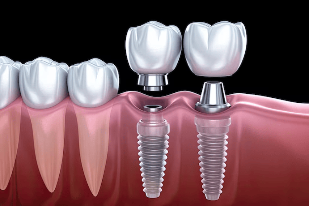 Difference Between Low-Cost Dental Care and Premium Dental Tourism