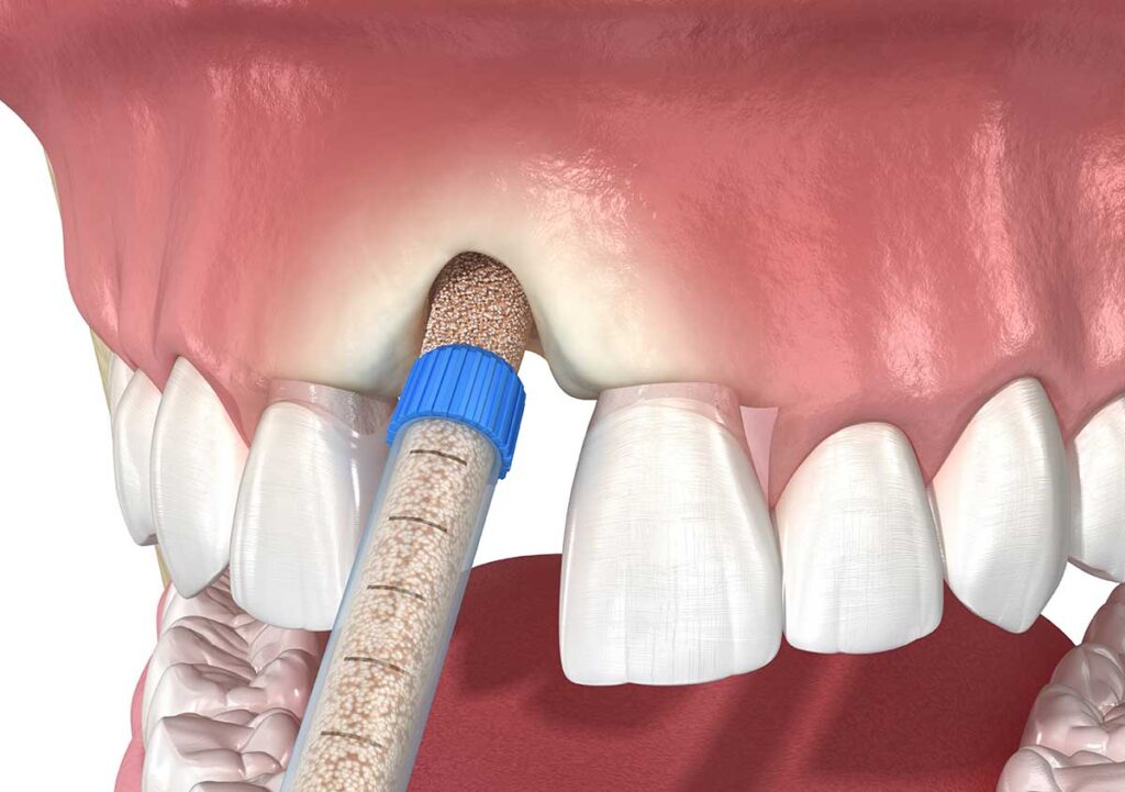 implant dentaire clinique dentaire santa catarina à porto