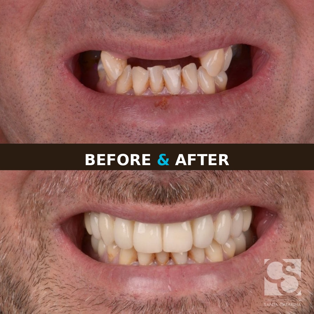 Full-mouth implant result at the Porto clinic Dental implants before and after in Porto, full mouth restoration result for Porto vs Budapest dental implants