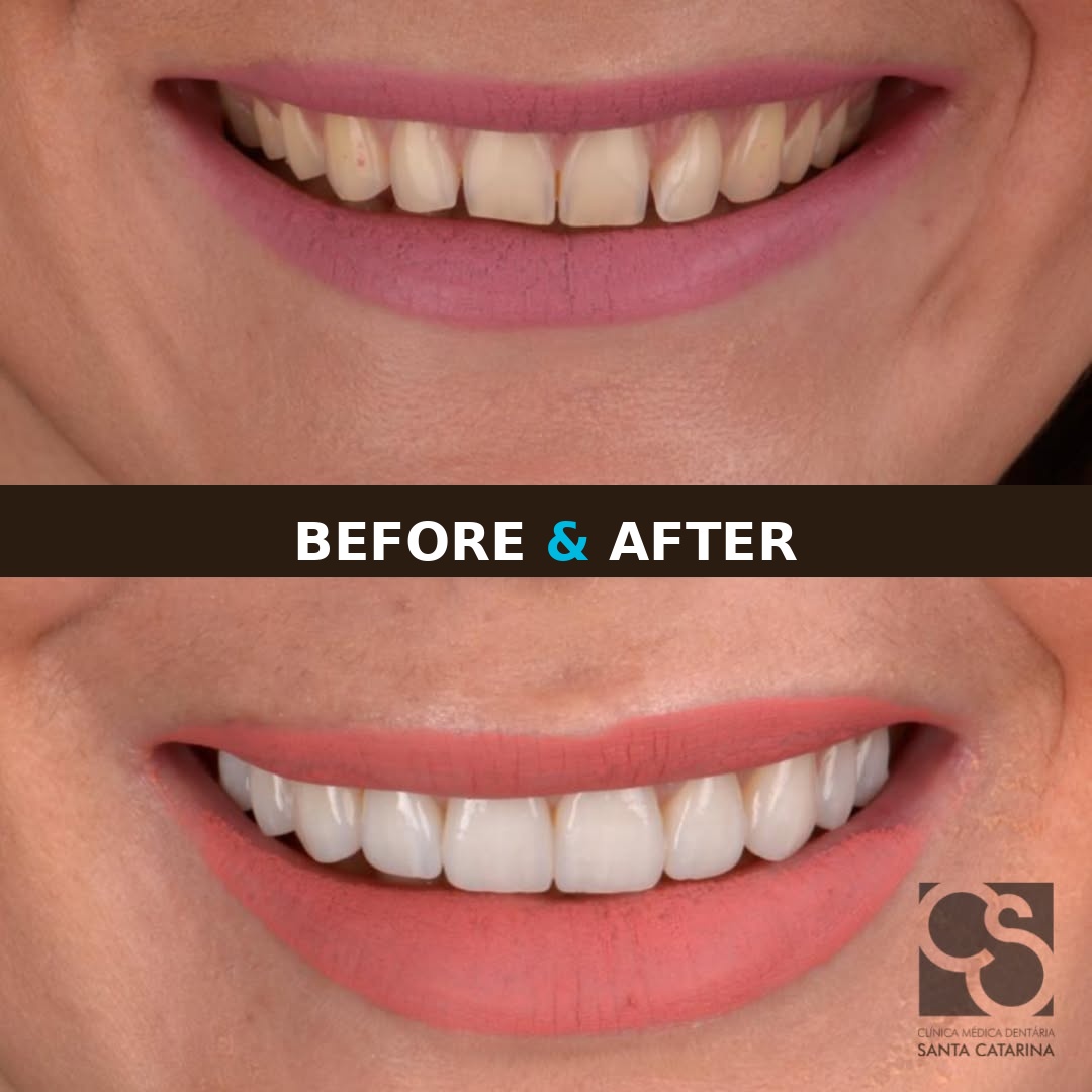Dental veneers before and after in Portugal – patient result at Perfeito Smile