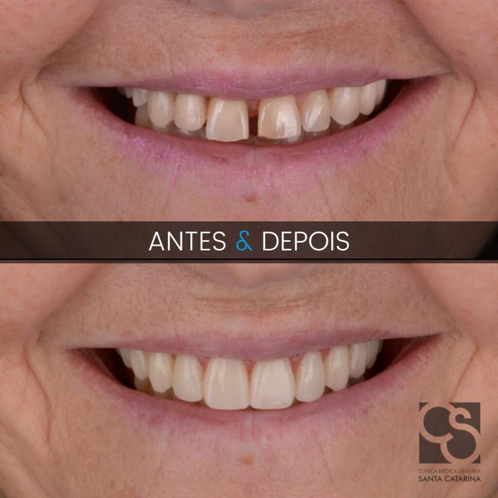 Porto vs Budapest dental implants before and after smile transformation at the Santa Catarina clinic in Porto