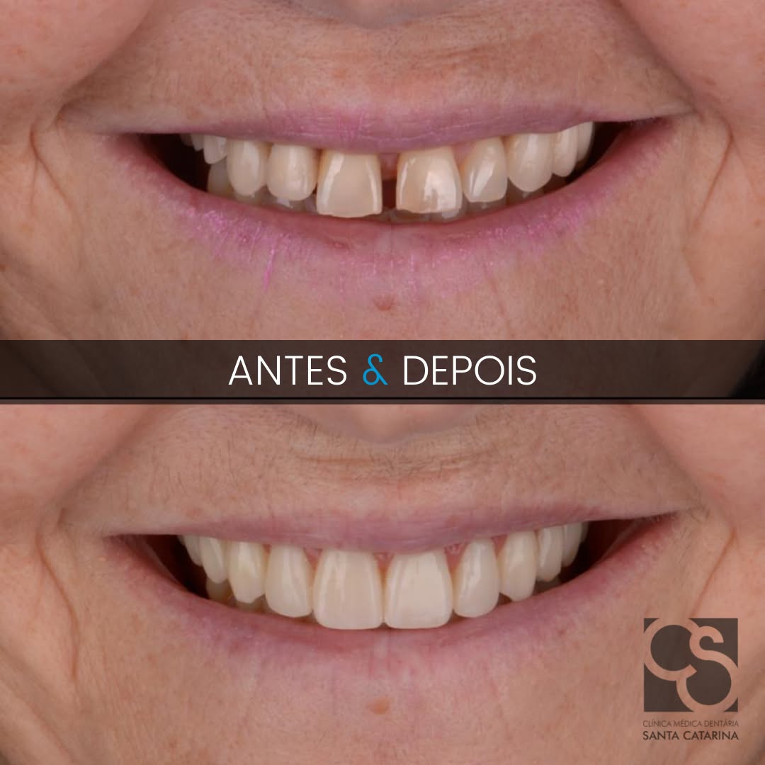 Porto vs Budapest dental implants before and after smile transformation at the Santa Catarina clinic in Porto