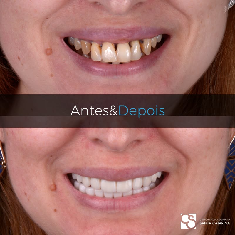Before and after case featuring combined esthetic restoration with ceramic facets and dental implants, showing smile harmony, natural enamel shade matching, and gingival contours