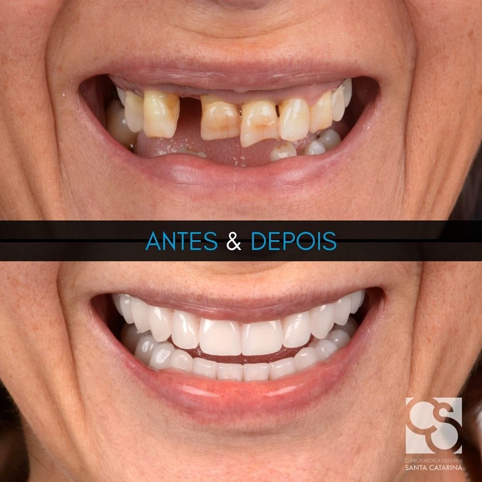 All-on-4 full mouth dental implant cost breakdown result before and after in Porto