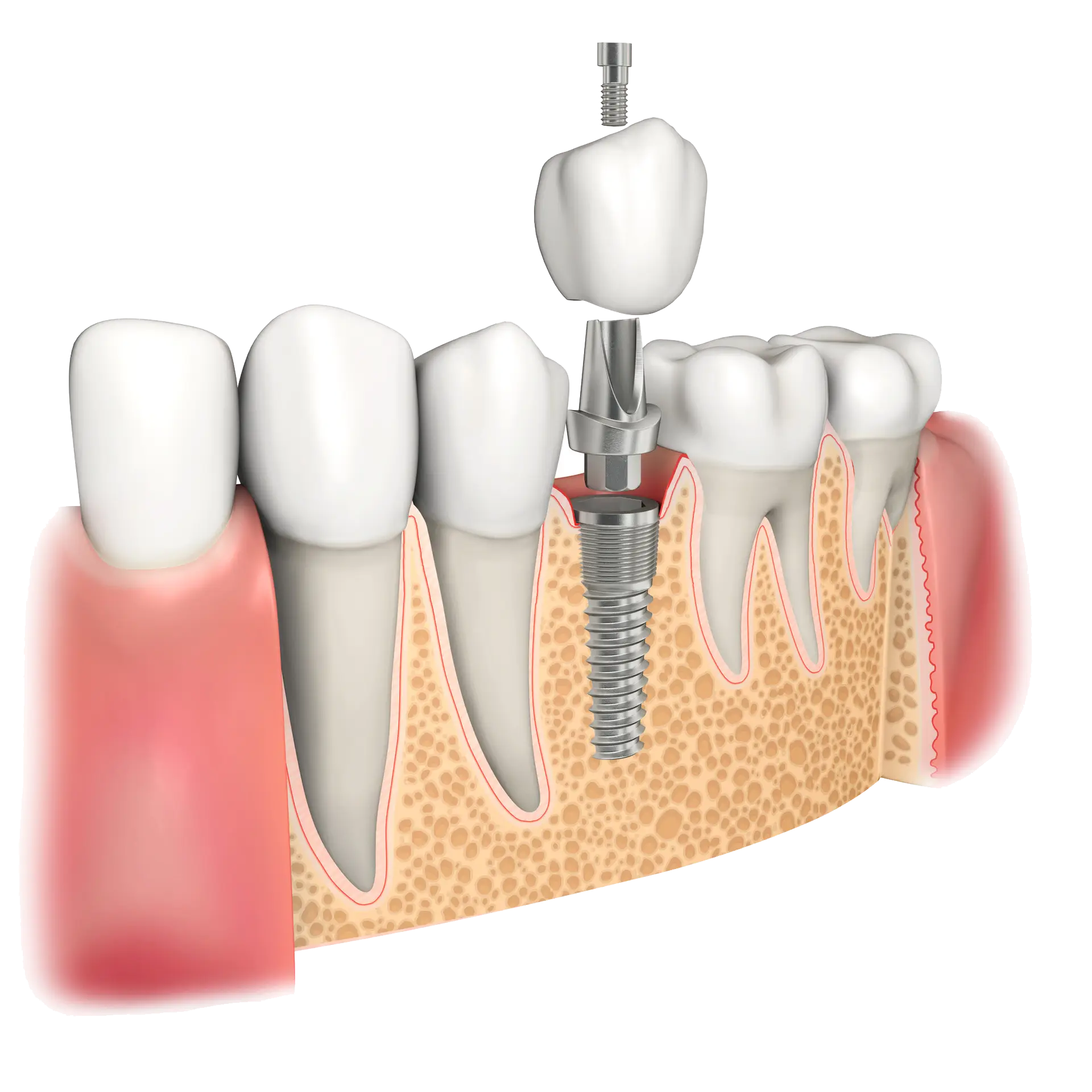 Schematic of a dental implant with titanium screw, abutment and crown explaining how long dental implants last