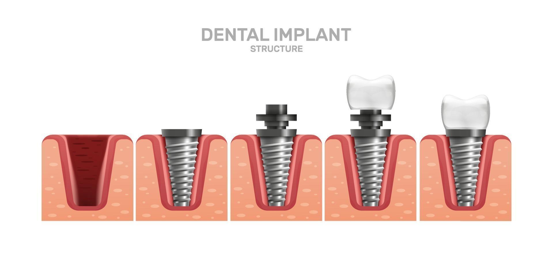4-phase infographic of implant placement steps that determine how long dental implants last