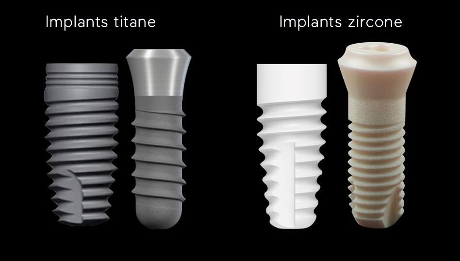 Comparaison entre un implant dentaire en titane et un implant en zircone