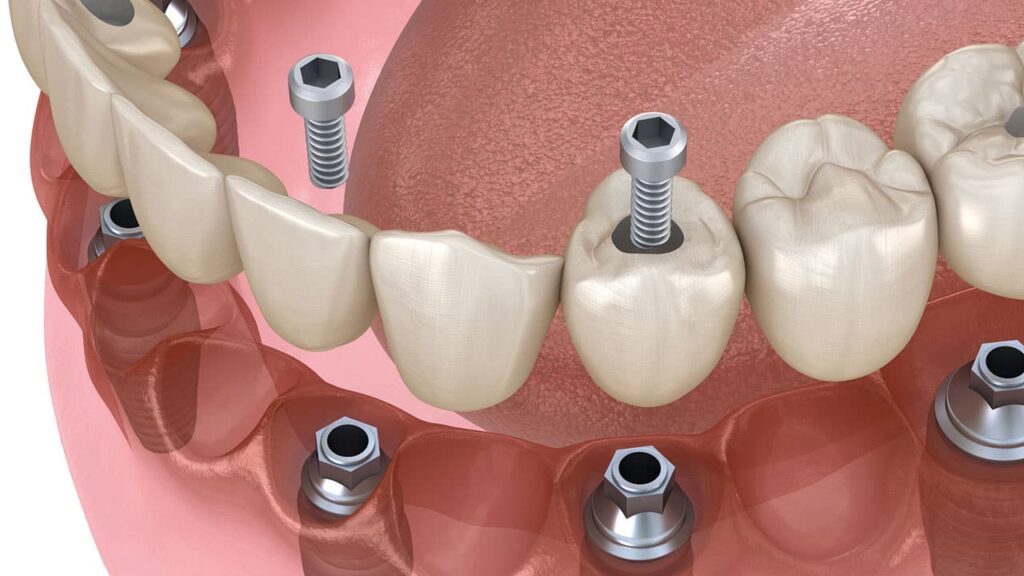 Prothèse dentaire transvissée sur implant : prix au Portugal