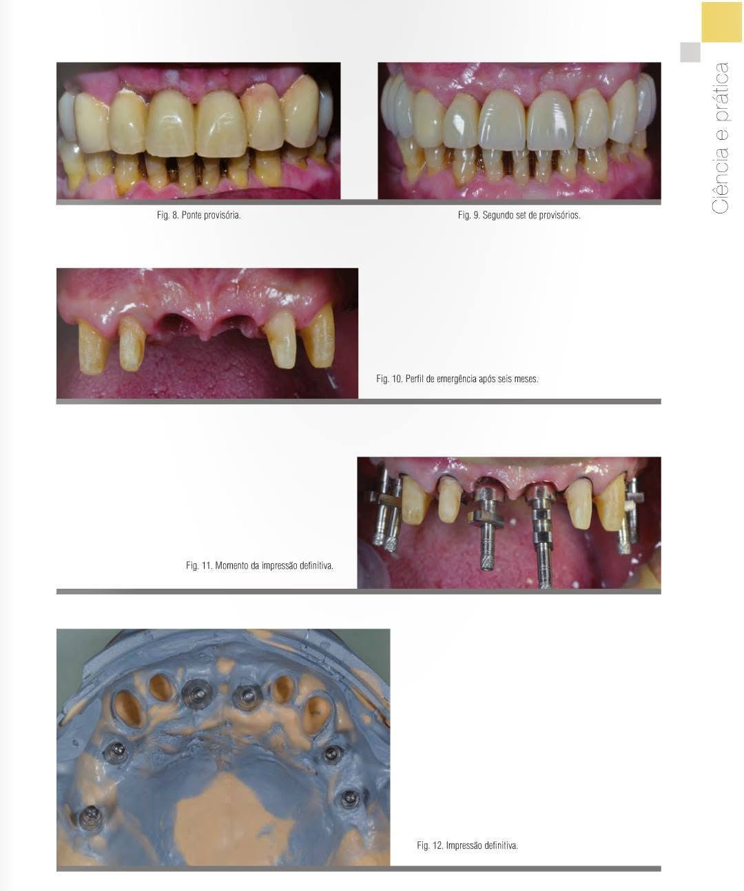 Dental implant in Porto – Expertise, modern technology and French-speaking support