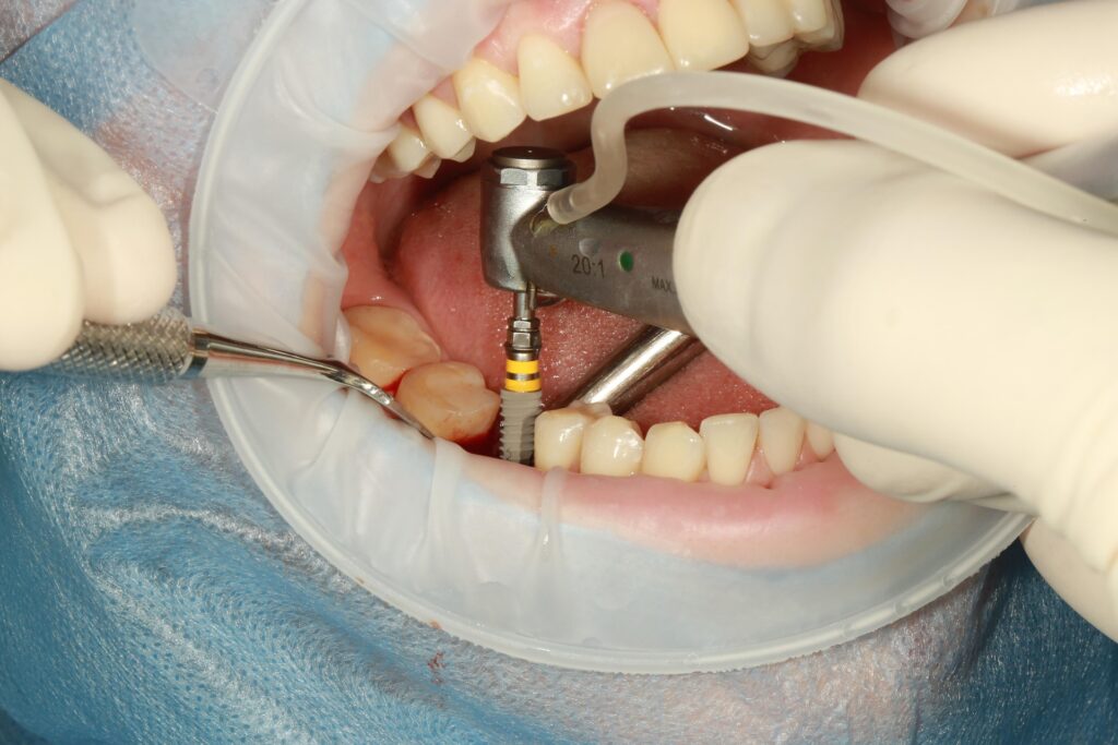 Dental implants without insurance in the USA: implant surgery at the Santa Catarina clinic in Porto