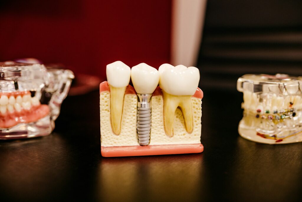 Single tooth implant cost in Portugal: implant model with crown shown at our Porto clinic