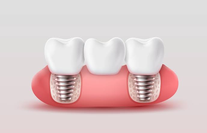 prix prothèse dentaire sur implant à l'étranger