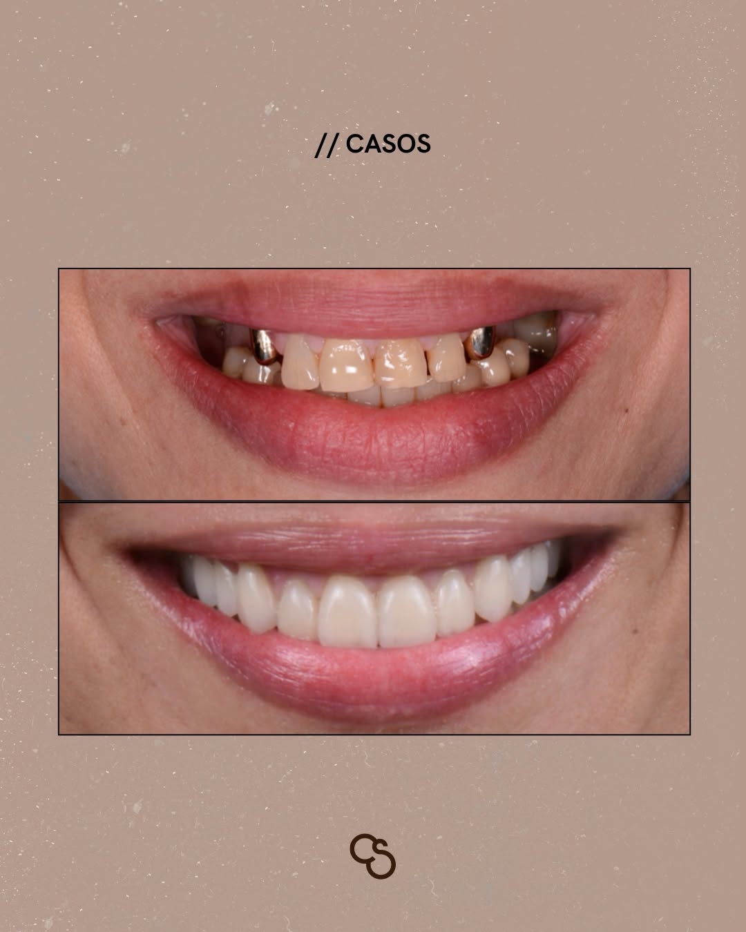 A-new-smile-new-confidence-Complete-oral-rehabilitation-Porto