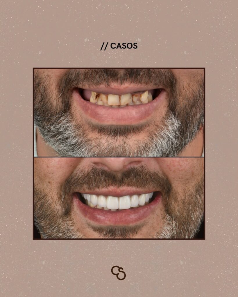 A new smile with dental implants and crowns in Porto, Portugal