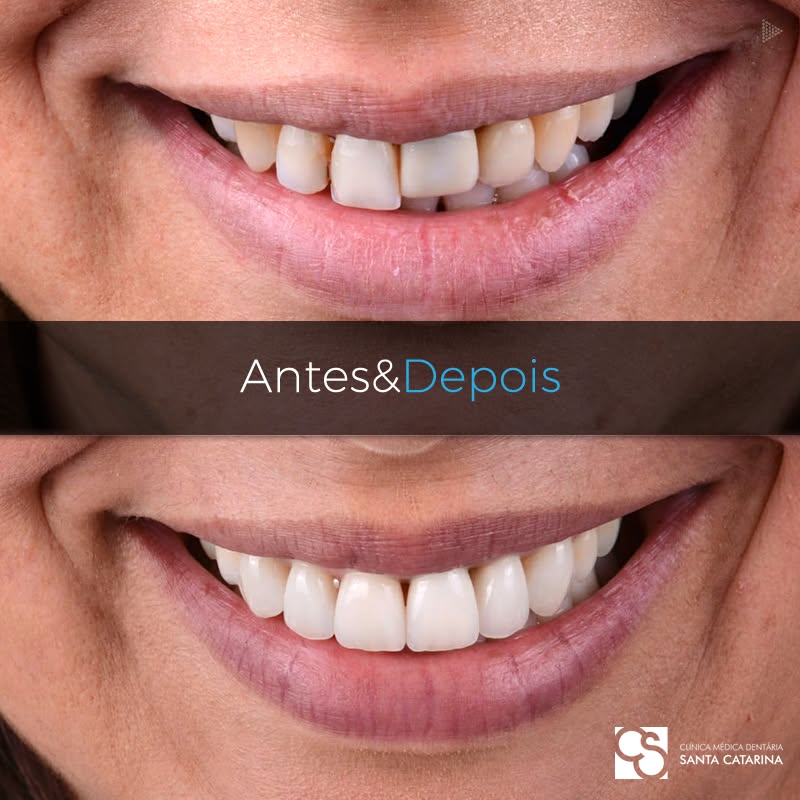 Aesthetic smile transformation in Porto, Portugal – Respecting natural tooth shape