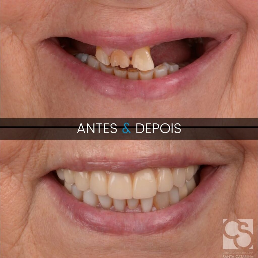 All-on-6 vs All-on-4 in Portugal: When Do You Actually Need Six Implants?