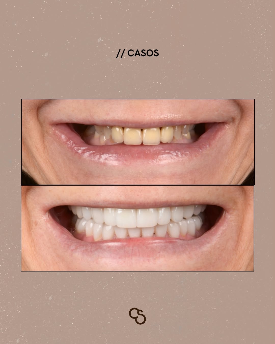 Before-After-Full-smile-reconstruction-All-on-4-Porto