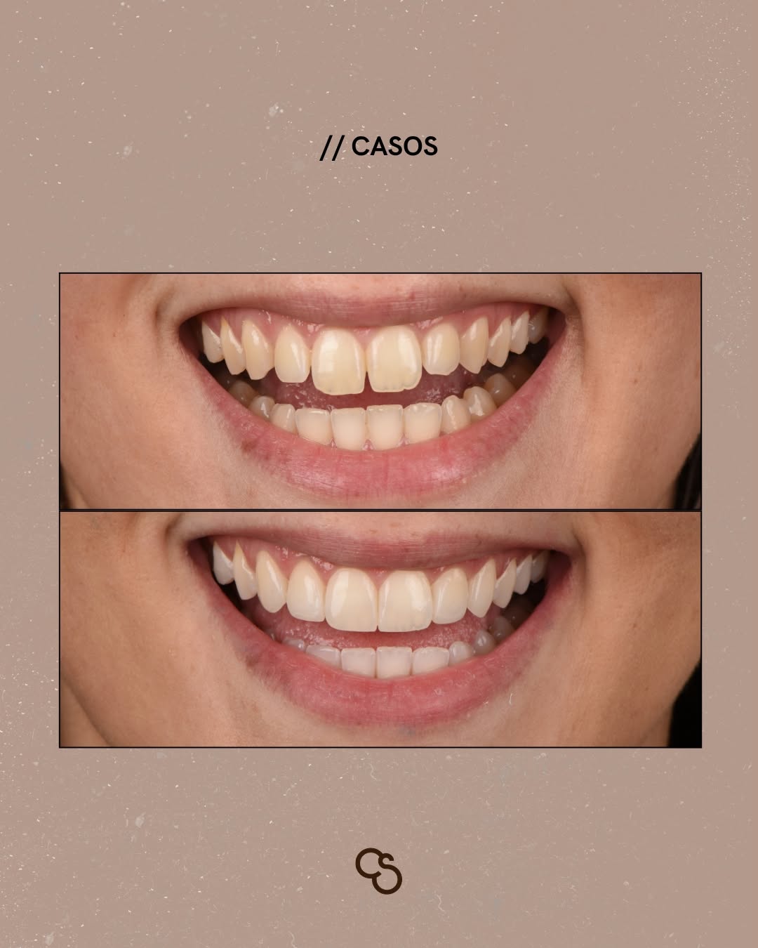 Before After dental veneers in Porto – A natural harmonious result
