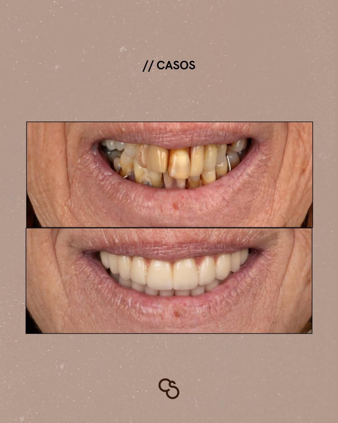 Before and after full smile with dental implants at 80 in Porto
