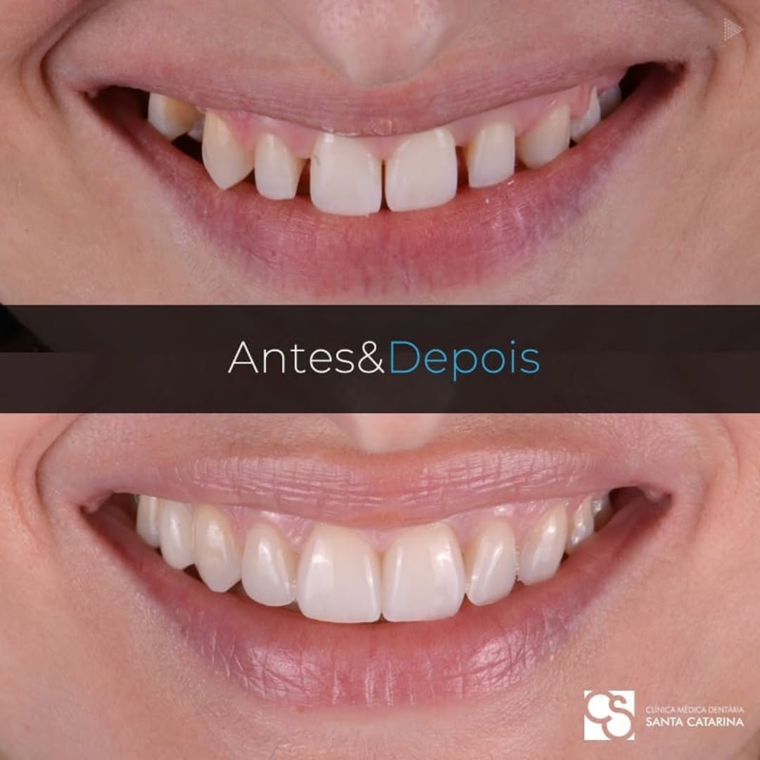 Ceramic veneers in Porto, Portugal – Diastema correction and smile harmony
