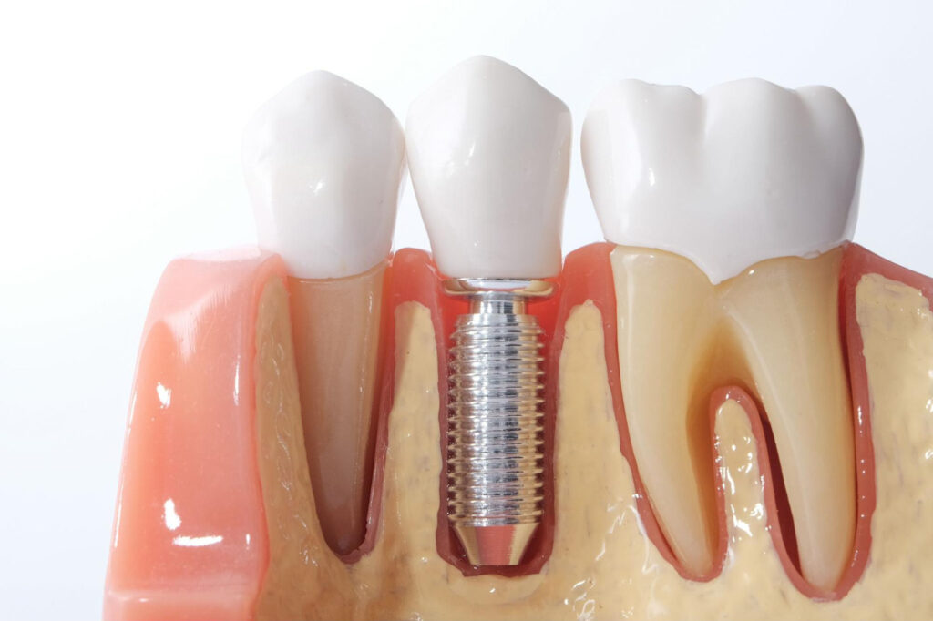 implant dentaire Straumann pas cher prix