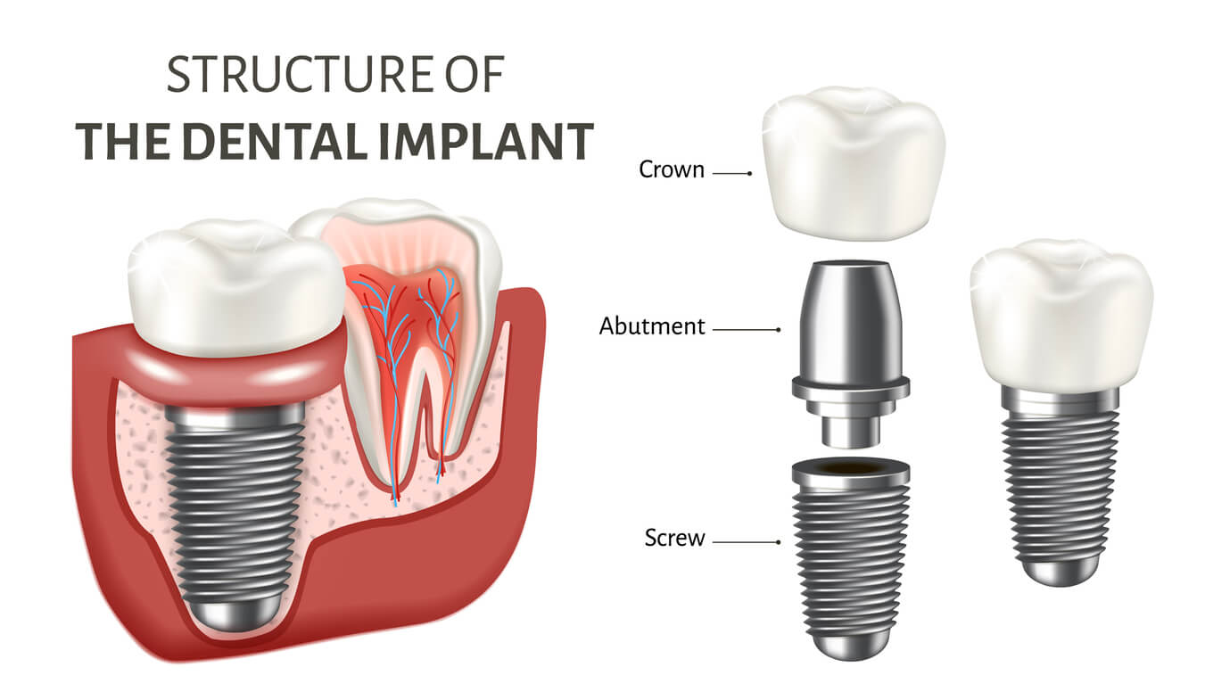 Dental Crown on Implant in Portugal: Zirconia vs Ceramic vs E-max — Price, Durability and Which to Choose - dental implants Porto UK patients