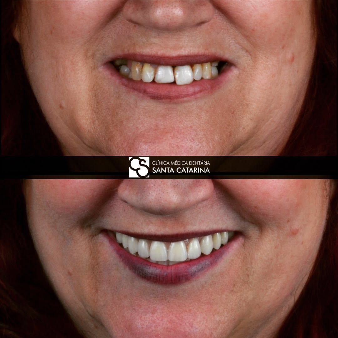 Dental anxiety implants Porto — patient smiling after All-on-4 with dental fear implants sedation